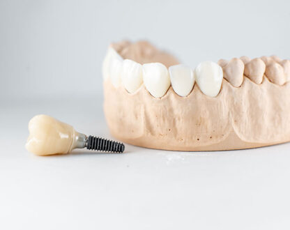 Rediscover Confidence: The Transformative Benefits of Dental Implants