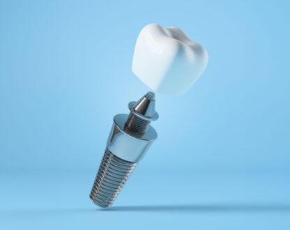 Dental Implants: A Permanent Solution to Missing Teeth