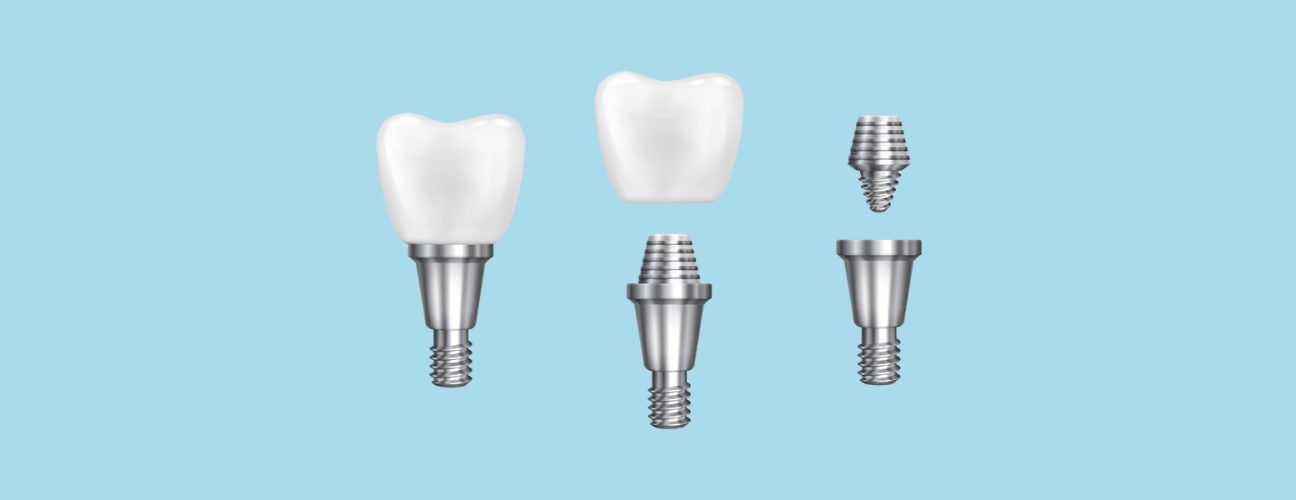 Before You Get Dental Implants in Montgomery – Read This First!