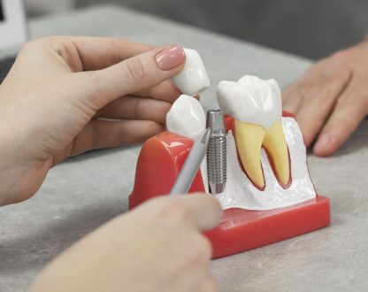 Dental Implants in Montgomery, AL, Dental Implants near me