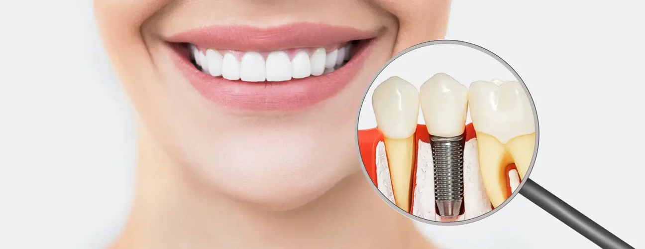 Who Is a Good Candidate for Dental Implants?