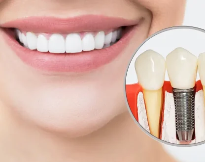 Who Is a Good Candidate for Dental Implants?